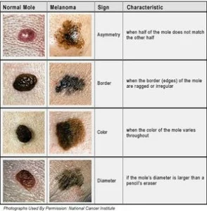 Mole Detection