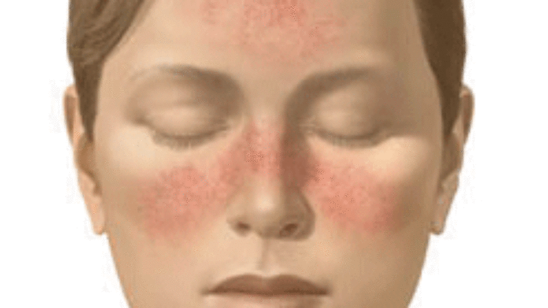Overview Of Rosacea: Causes And Treatment