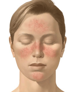 You are currently viewing Overview Of Rosacea: Causes And Treatment