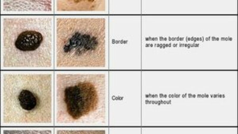 ABC of Skin Cancer and Mole Detection