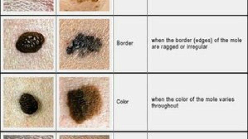 here-naturally-how-to-get-rid-of-skin-moles-skin-moles-skin-tissue