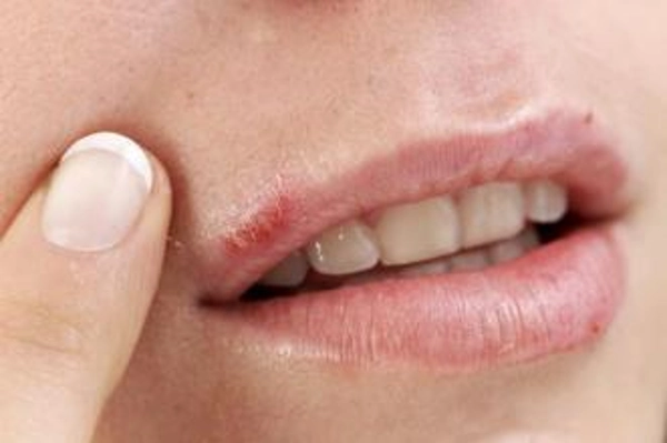 You are currently viewing Cold Sores 101: The Basics