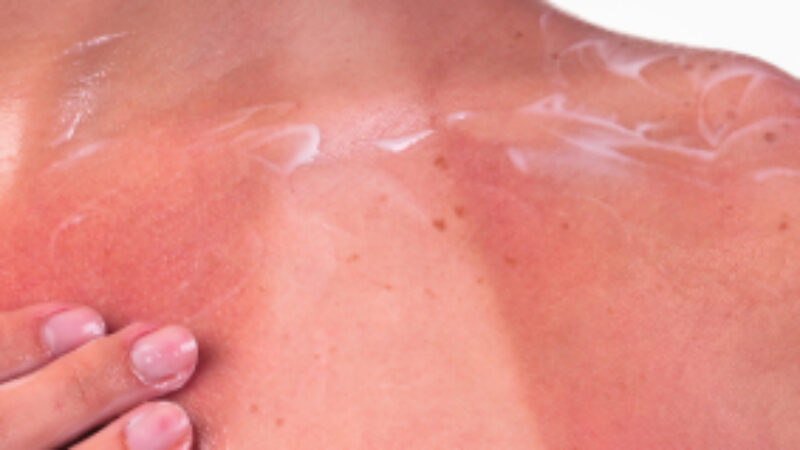 The Science Behind A Sunburn