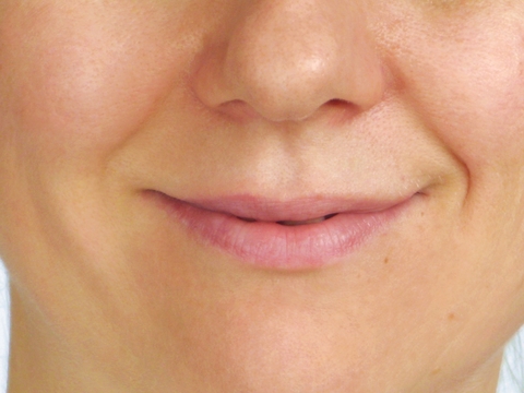 You are currently viewing Nasolabial Folds