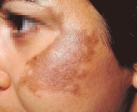 You are currently viewing MELASMA AND RETINOL