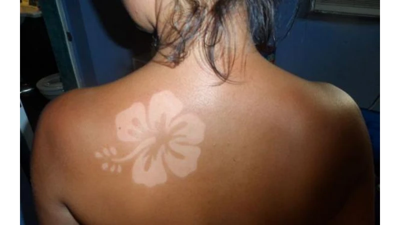 Sunburn Tattoos