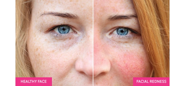 Dermakalm Rosa Cream Before and After