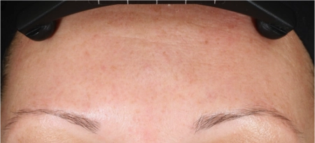 After Neostrata Dual Acid Antiaging Peel