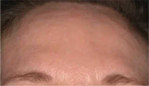 After Neostrata Smooth Surface Glycolic Peel