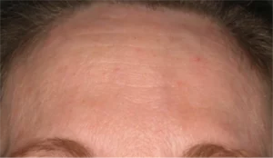 Before Neostrata Smooth Surface Glycolic Peel